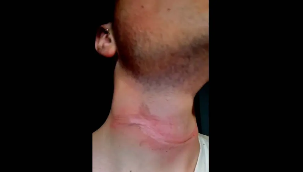 Villa de Merlo: un joven de 22 años casi es decapitado por un cable caído en la calle